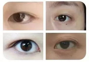 眼型算命(有胃病，眼白有u型血丝，严重吗)-星座123